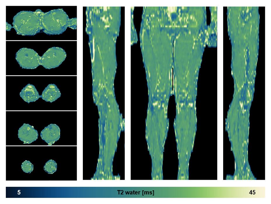 The water only T2 relaxation time of the lower extremity obtained from multi echo spin echo t2 mapping with EPG based reconstruction.